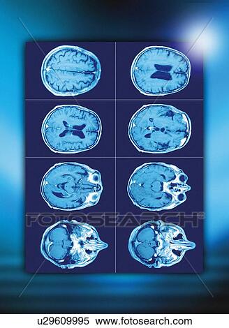 Stock Photography - Normal brain, CT scans. Fotosearch
