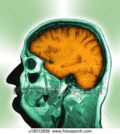 Stock Photo - Normal brain, MRI scan. Fotosearch