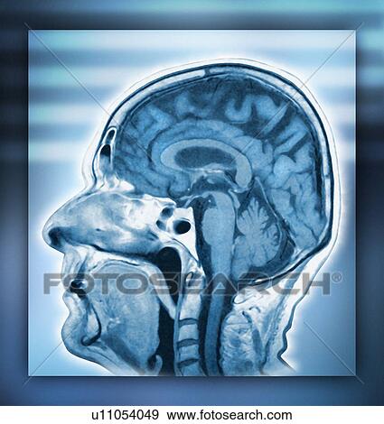 Stock Photo - Normal head and brain, MRI scan. Fotosearch