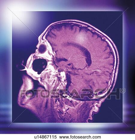 Normal head and brain, MRI scan View Large Photo Image Stock Photography - Normal head and brain, MRI scan. Fotosearch