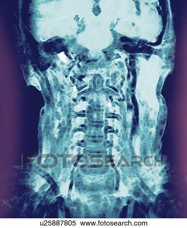 Normal head and neck, MRI scan View Large Photo Image Stock Photography - Normal head and neck, MRI scan. Fotosearch
