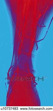 Stock Image - Normal leg veins, angiogram. Fotosearch