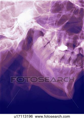 Normal lower jaw, X-ray View Large Photo Image Stock Photograph - Normal lower jaw, X-ray. Fotosearch