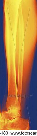Normal lower leg, X-ray View Large Photo Image Stock Image - Normal lower leg, X-ray. Fotosearch
