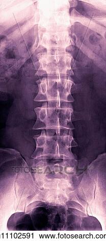 Normal lumbar spine, X-ray View Large Photo Image Stock Image - Normal lumbar spine, X-ray. Fotosearch