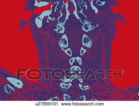 Stock Image - Normal neck, CT scan. Fotosearch