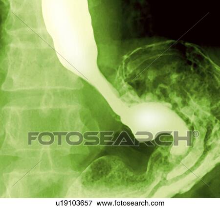 Normal oesophagus and stomach, X-ray View Large Photo Image Stock Photo - Normal oesophagus and stomach, X-ray. Fotosearch