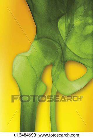 Normal pelvic veins, venogram View Large Photo Image Stock Image - Normal pelvic veins, venogram. Fotosearch
