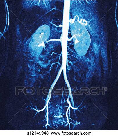 Normal renal arteries, MRA scan View Large Photo Image Stock Photo - Normal renal arteries, MRA scan. Fotosearch