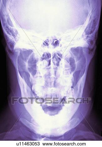 Normal skull, X-ray View Large Photo Image Stock Image - Normal skull, X-ray. Fotosearch