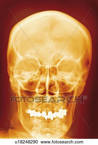 Normal skull, X-ray View Large Photo Image Stock Image - Normal skull, X-ray. Fotosearch