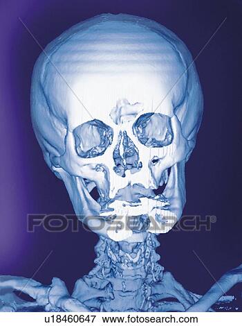 Stock Photo - Normal skull, X-ray. Fotosearch