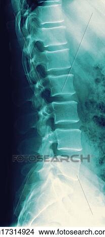 Normal spine, X-ray View Large Photo Image Picture - Normal spine, X-ray. Fotosearch