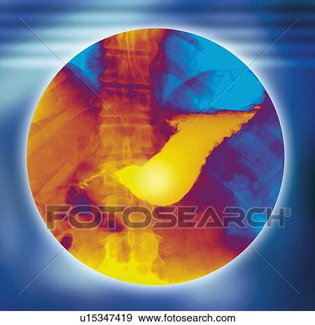Stock Photo - Normal stomach, X-ray. Fotosearch
