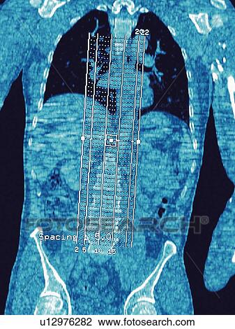 Stock Image - Normal torso, CT scan. Fotosearch