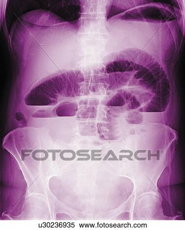 Stock Photography - Occluded intestine, X-ray. Fotosearch