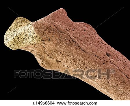 Osteoporotic bone, SEM View Large Photo Image Picture - Osteoporotic bone, SEM. Fotosearch