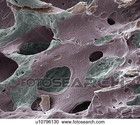 Osteoporotic bone, SEM View Large Photo Image Stock Image - Osteoporotic bone, SEM. Fotosearch