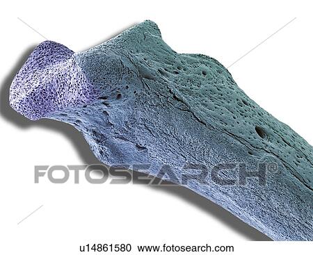 Stock Image - Osteoporotic bone, SEM. Fotosearch