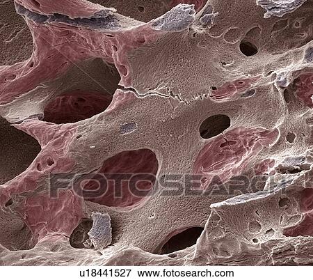 Osteoporotic bone, SEM View Large Photo Image Stock Photo - Osteoporotic bone, SEM. Fotosearch