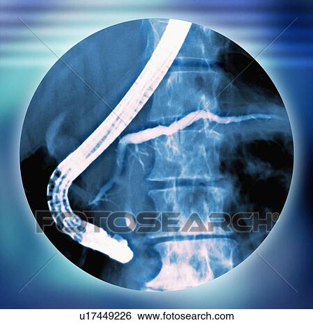Stock Photograph - Pancreas examination, X-ray. Fotosearch
