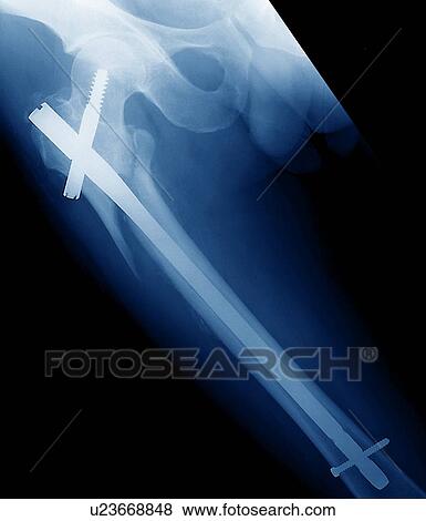 Pinned broken leg, X-ray View Large Photo Image Stock Photo - Pinned broken leg, X-ray. Fotosearch