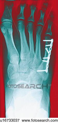 Stock Photo - Pinned foot bone fracture, X-ray. Fotosearch