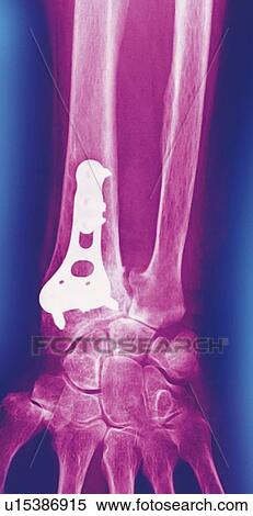Pinned wrist fracture, X-ray View Large Photo Image Stock Photography - Pinned wrist fracture, X-ray. Fotosearch