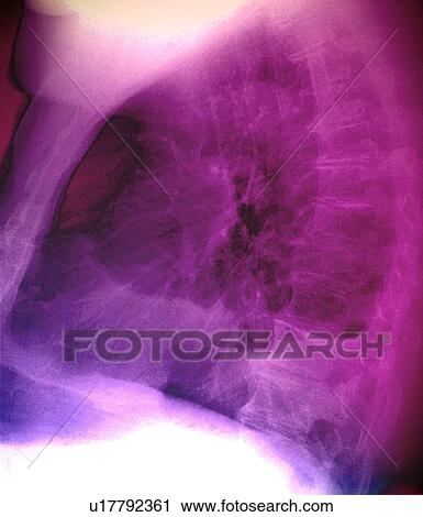 Pleural effusion, X-ray View Large Photo Image Stock Image - Pleural effusion, X-ray. Fotosearch