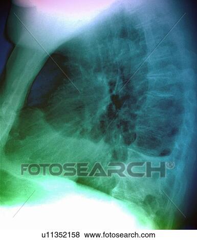 Stock Photo - Pleural effusion, X-ray. Fotosearch