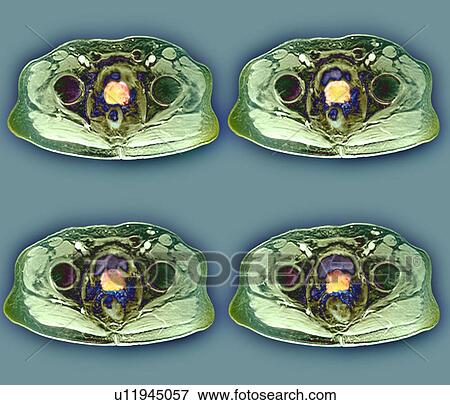 Prostate cancer, MRI scans View Large Photo Image Stock Photo - Prostate cancer, MRI scans. Fotosearch