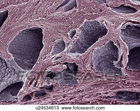 Stock Image - Prostate cancer, SEM. Fotosearch