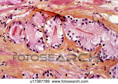 Stock Photo - Prostate cancer. Fotosearch