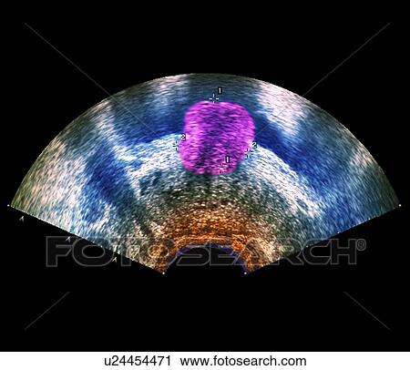 Stock Image - Prostate tumour, ultrasound scan. Fotosearch