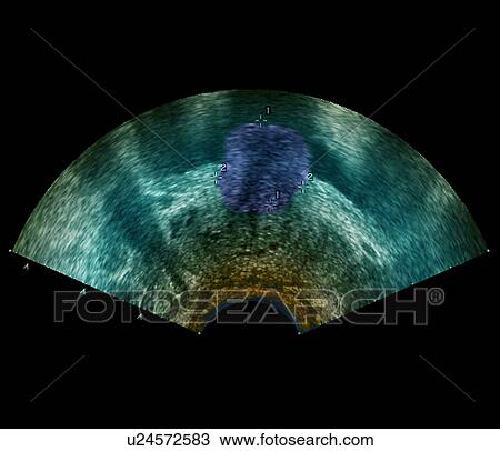 Prostate tumour, ultrasound scan View Large Photo Image Stock Image - Prostate tumour, ultrasound scan. Fotosearch