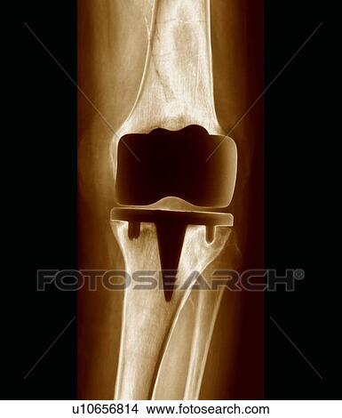 Prosthetic knee joint, X-ray View Large Photo Image Picture - Prosthetic knee joint, X-ray. Fotosearch