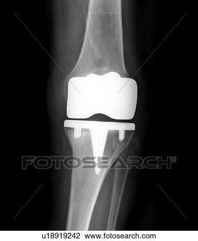 Prosthetic knee joint, X-ray View Large Photo Image Stock Image - Prosthetic knee joint, X-ray. Fotosearch