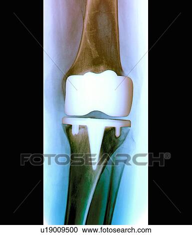 Stock Image - Prosthetic knee joint, X-ray. Fotosearch
