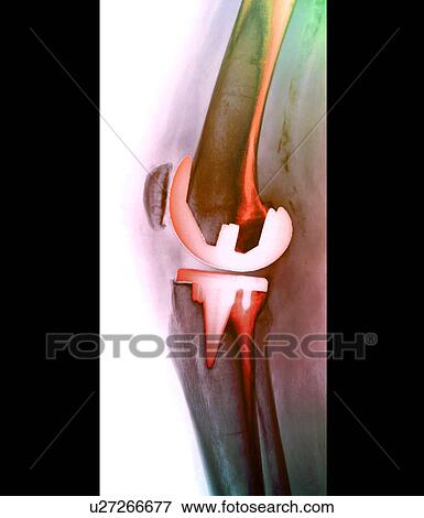 Prosthetic knee joint, X-ray View Large Photo Image Stock Photo - Prosthetic knee joint, X-ray. Fotosearch