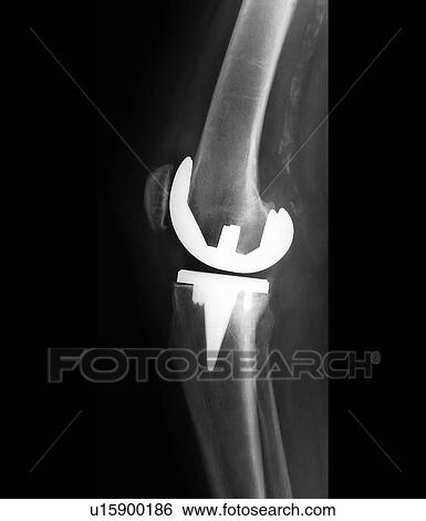 Prosthetic knee joint, X-ray View Large Photo Image Stock Photograph - Prosthetic knee joint, X-ray. Fotosearch