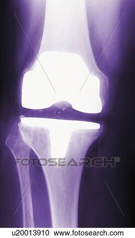 Prosthetic knee, X-ray View Large Photo Image Stock Image - Prosthetic knee, X-ray. Fotosearch