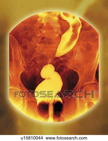 Rectal cancer, X-ray View Large Photo Image Picture - Rectal cancer, X-ray. Fotosearch