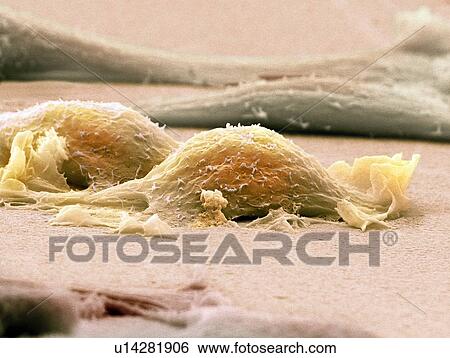 Sarcoma cells, SEM View Large Photo Image Stock Photograph - Sarcoma cells, SEM. Fotosearch