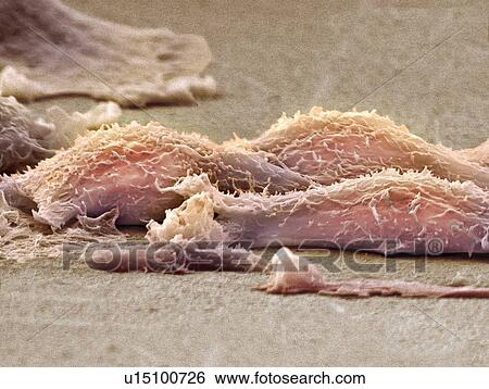 Stock Photograph - Sarcoma cells, SEM. Fotosearch