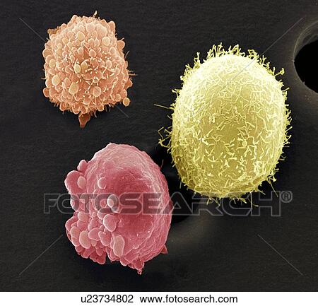 Stock Image - Skin cancer cells, SEM. Fotosearch