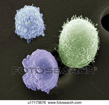 Skin cancer cells, SEM View Large Photo Image Stock Photograph - Skin cancer cells, SEM. Fotosearch