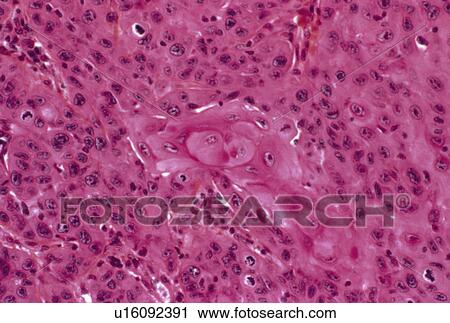 Skin cancer, light micrograph View Large Photo Image Stock Image - Skin cancer, light micrograph. Fotosearch