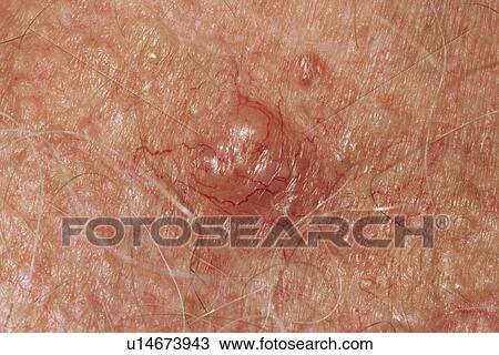 Skin cancer View Large Photo Image Stock Image - Skin cancer. Fotosearch