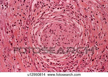Picture - Stomach ulcer, light micrograph. Fotosearch
