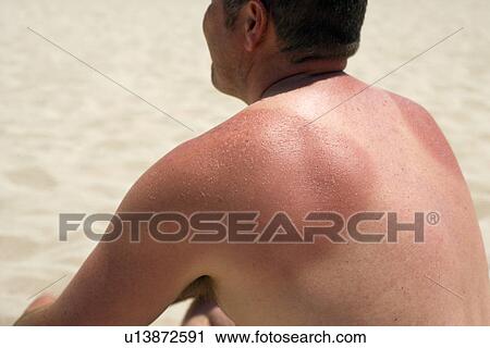 Sunburn View Large Photo Image Stock Image - Sunburn. Fotosearch